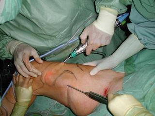 Comme traiter la thrombose du pied