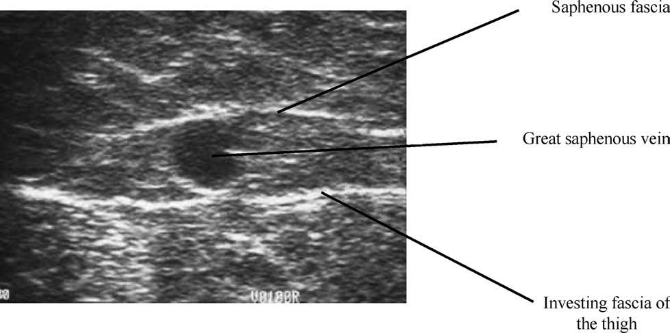 Duplex ultrasound investigation of the veins in chronic venous disease