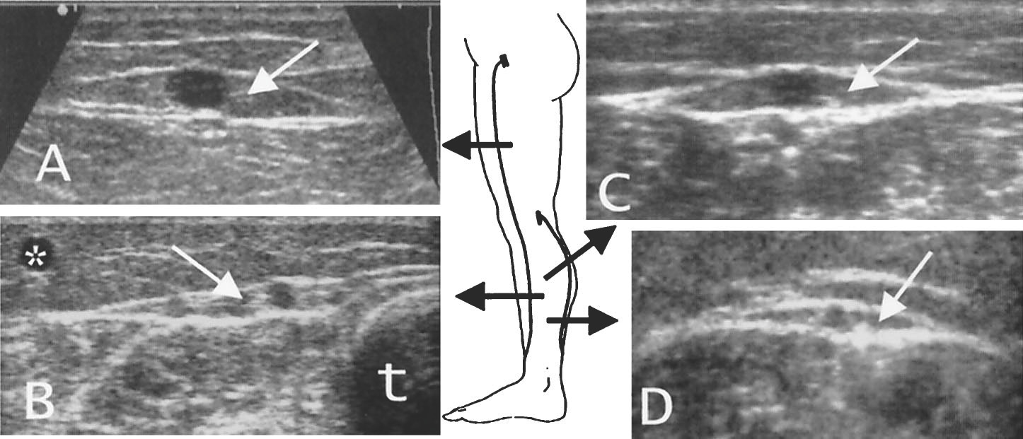 Nomenclature of the veins of the lower limbs : An international